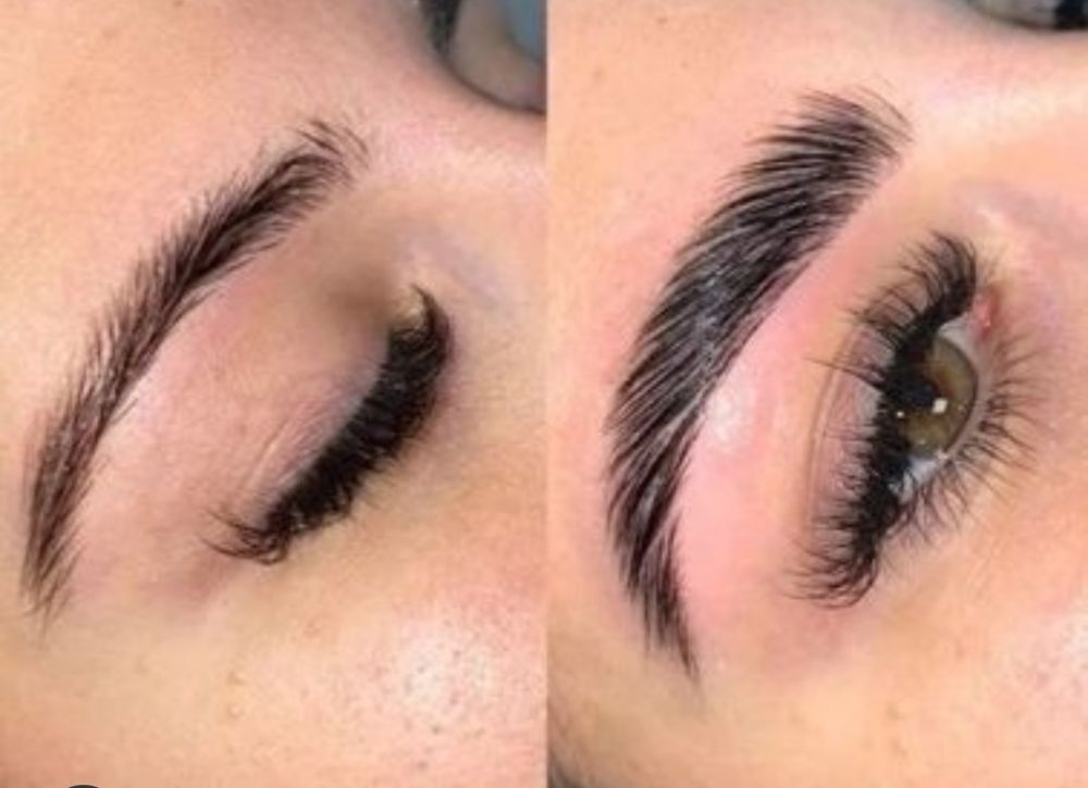 Browlift 1