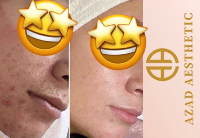 Microneedling